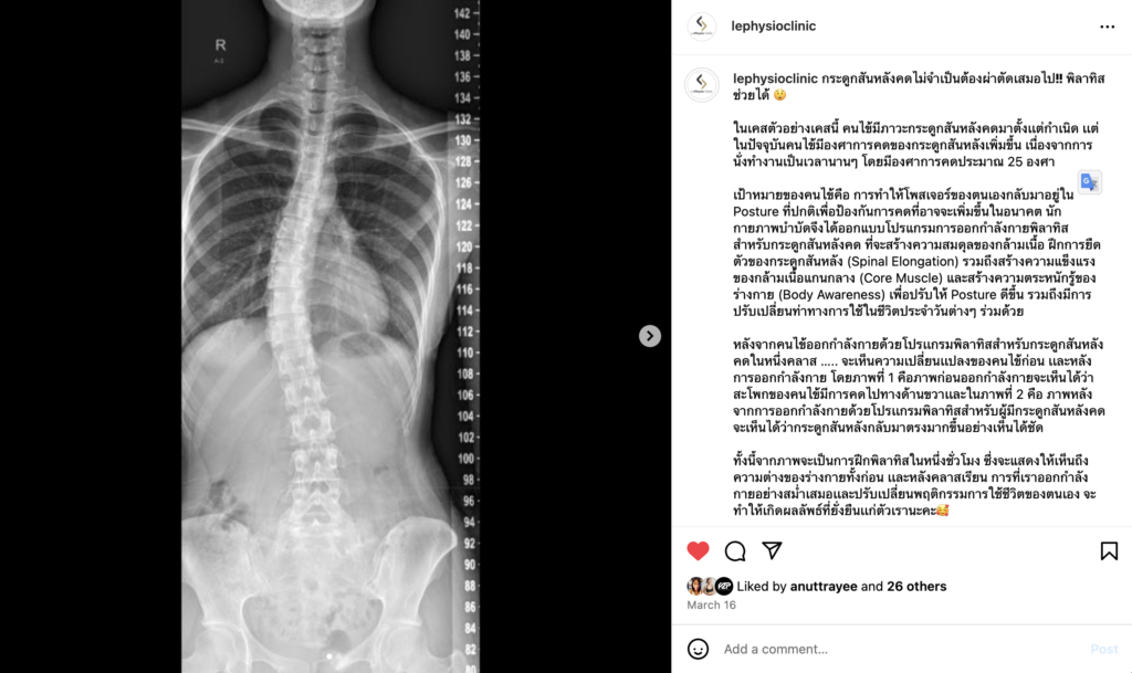 กายภาพบำบัดรักษาโรคกระดูกสันหลังคด