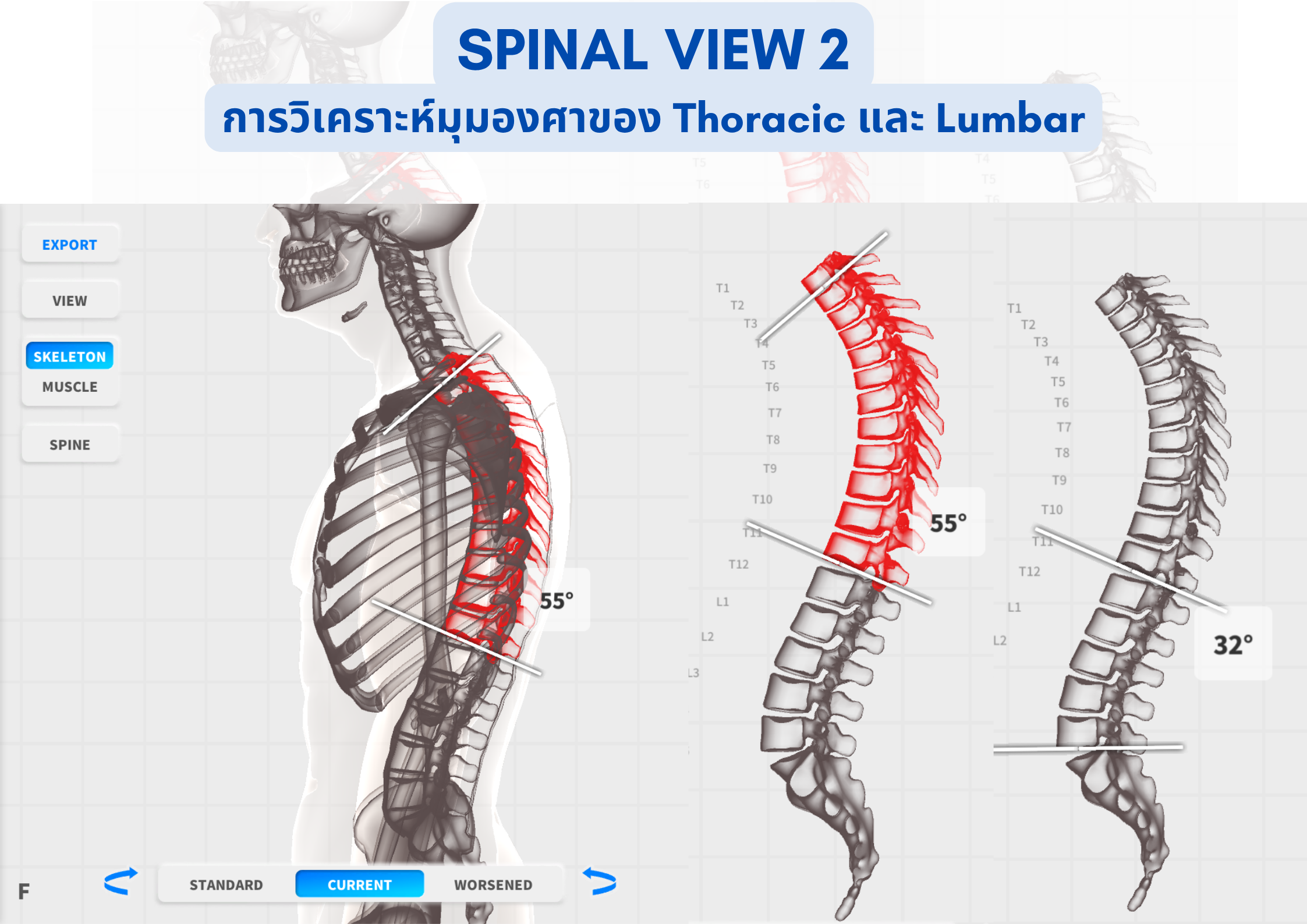 Scoliosis Physiotherapy treatment asoke and chidlom